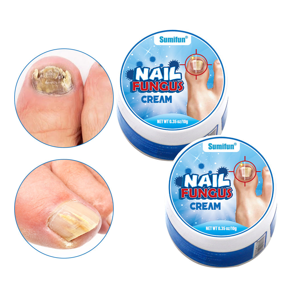 كريم علاج فطريات الأظافر
